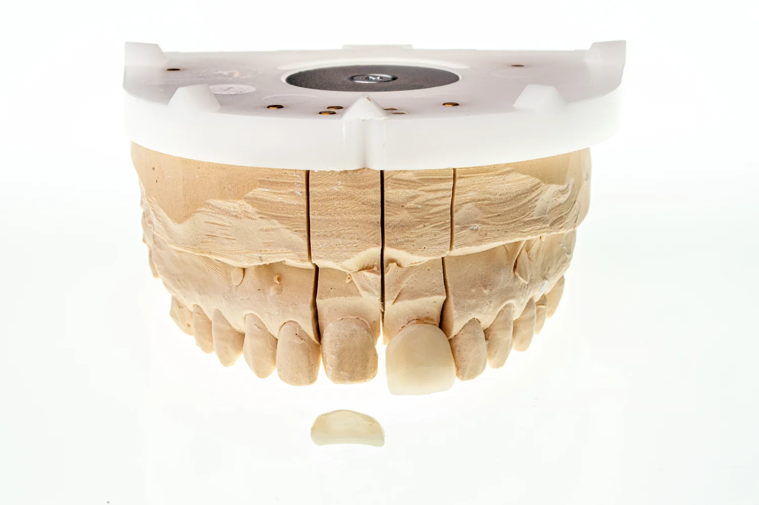 modello di arcata dentale superiore dopo l'applicazione di una faccetta dentale