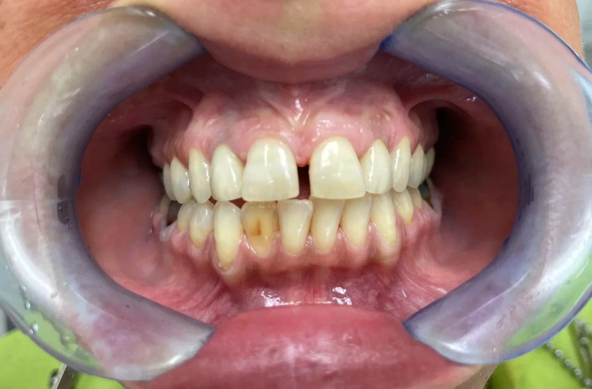 caso-studio-estetica-dentale-02-prima-ok