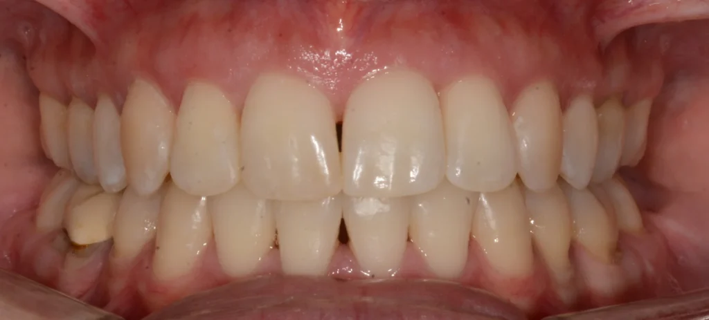 Primissimo piano di una bocca aperta con le arcate dentali dopo l'intervento