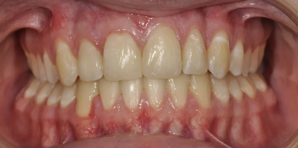 Primissimo piano di una bocca aperta con le arcate dentali dopo l'intervento