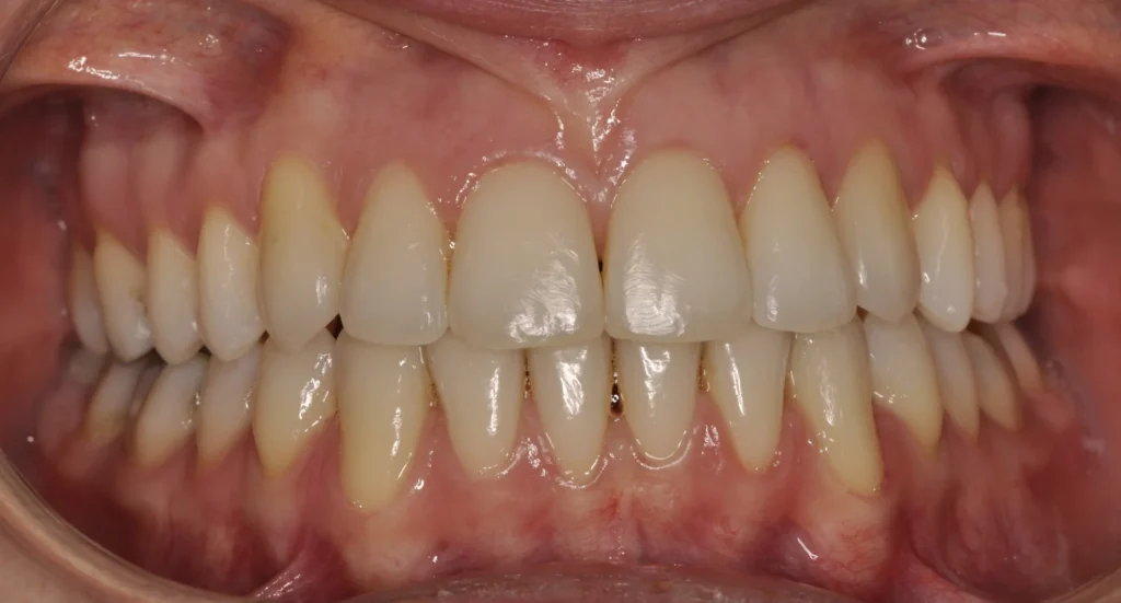 Primissimo piano di una bocca aperta con le arcate dentali dopo l'intervento
