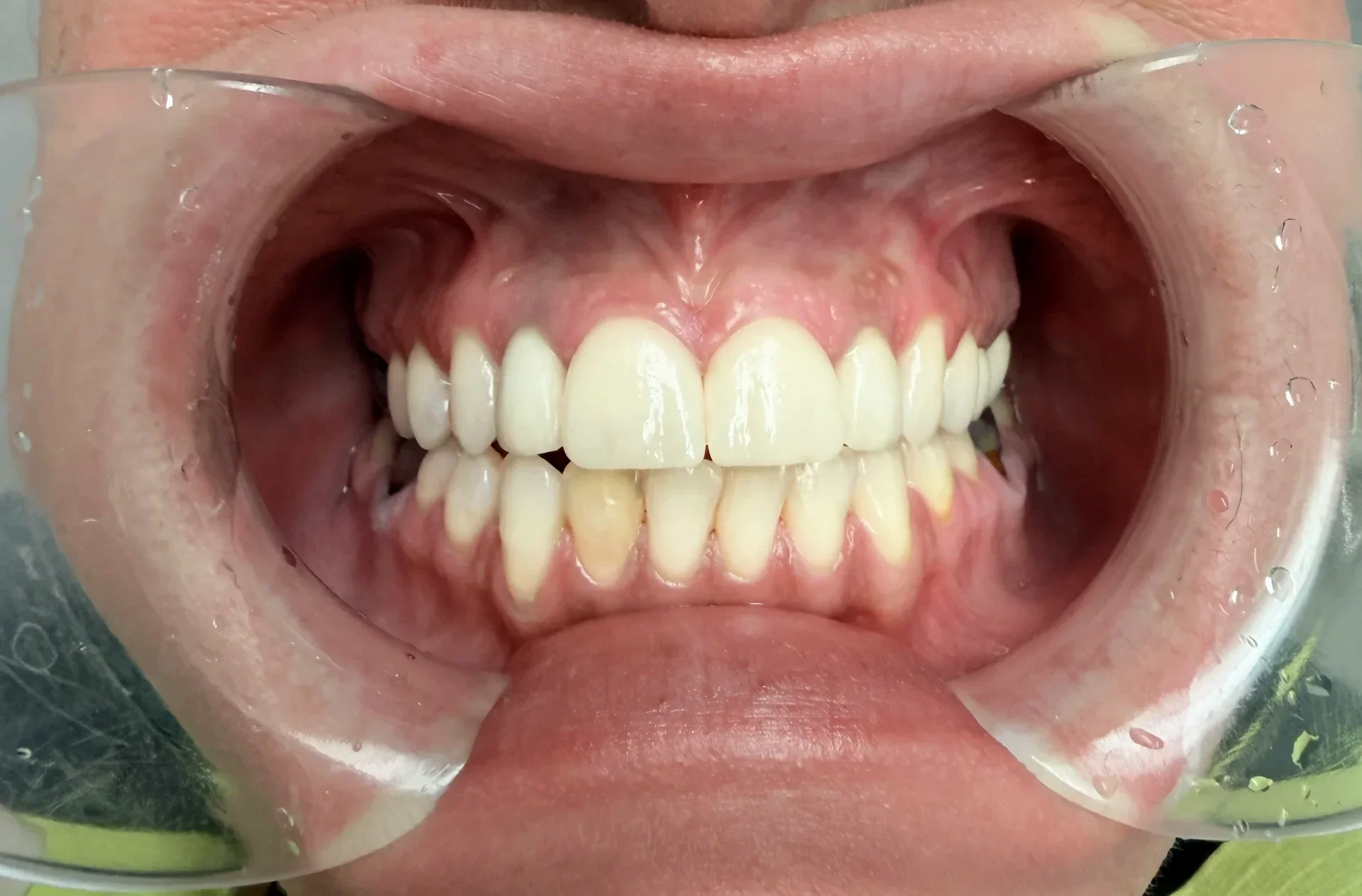 Primissimo piano di una bocca aperta con le arcate dentali dopo l'intervento