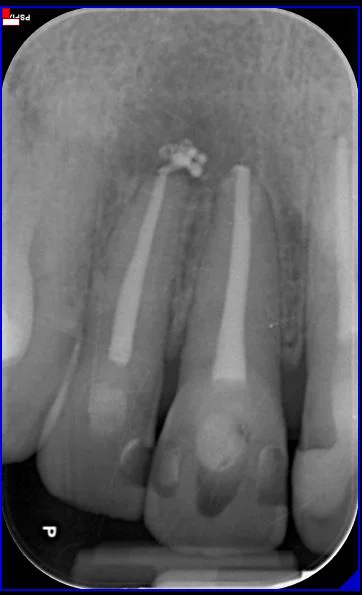 radiografia-endodonzia-01-b
