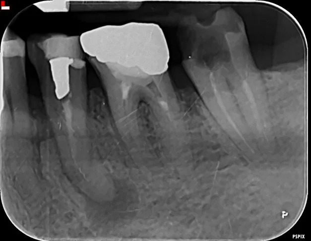 radiografia-endodonzia-02-a