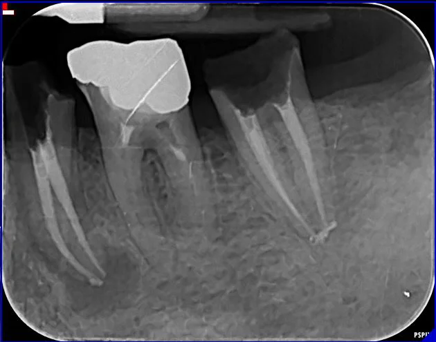 radiografia-endodonzia-02-b