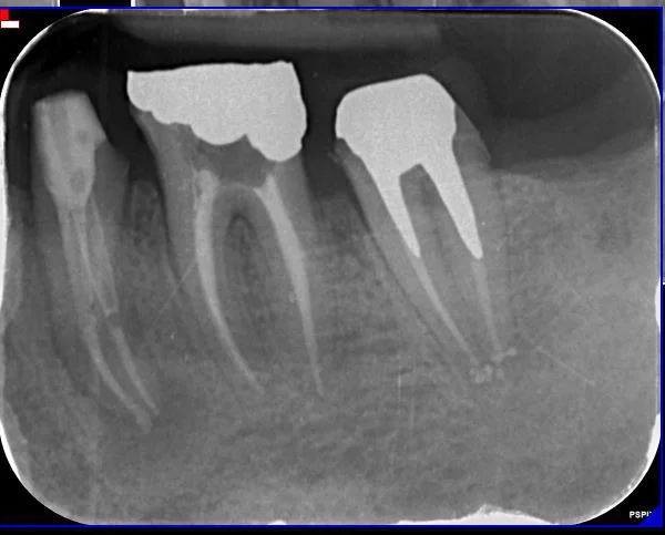 radiografia-endodonzia-02-c