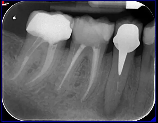 radiografia-endodonzia-03-a