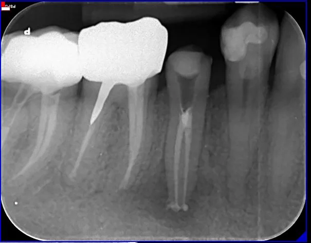 radiografia-endodonzia-03-b